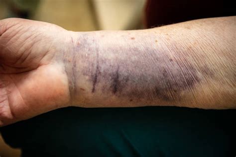 Hematoma on arm pictures. Things To Know About Hematoma on arm pictures. 